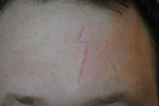 before scar treatment
