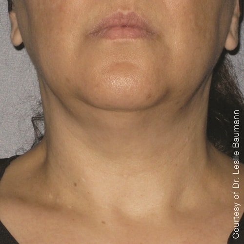 After Ultherapy Neck Treatment