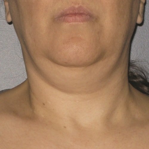 Before Ultherapy Neck Treatment