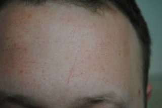 after scar treatment