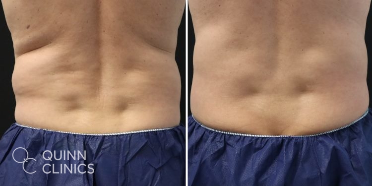 before and after male coolsculpting
