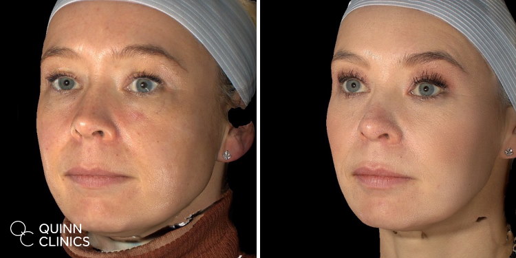before and after botox and fillers