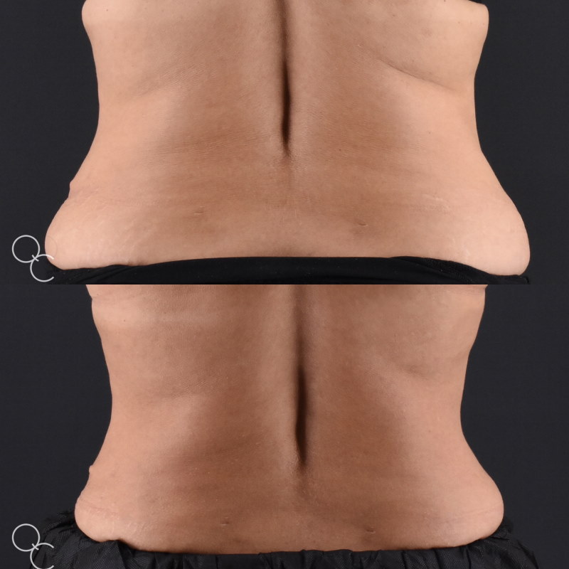 Coolsculpting flanks results