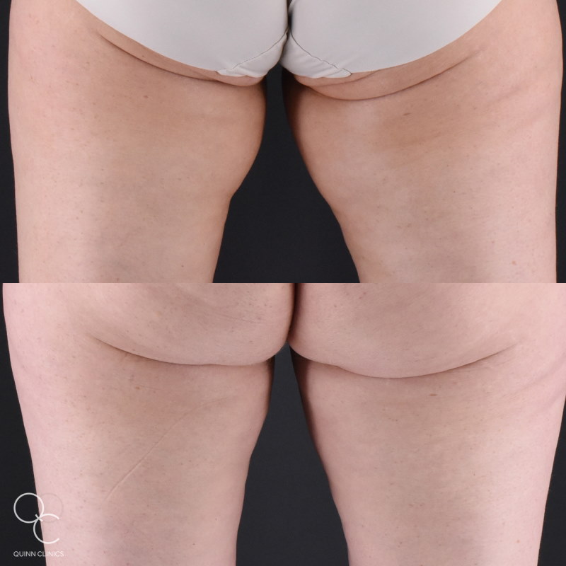coolsculpting thighs results