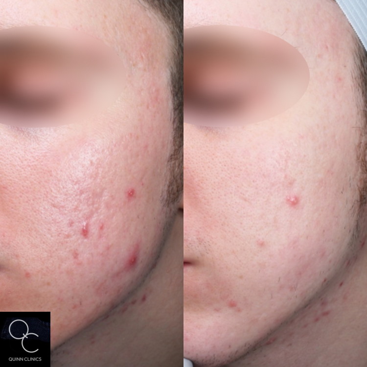before and after acne scarring treatment