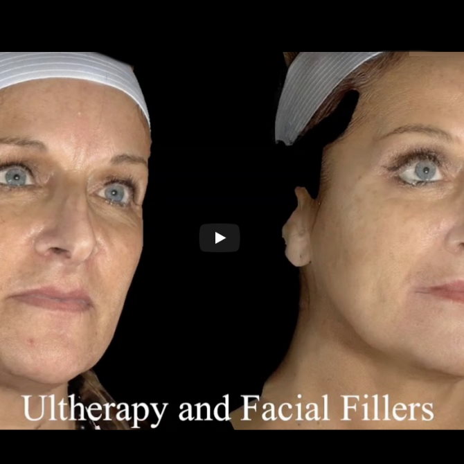 Ultherapy & Facial Fillers, Before & After Results