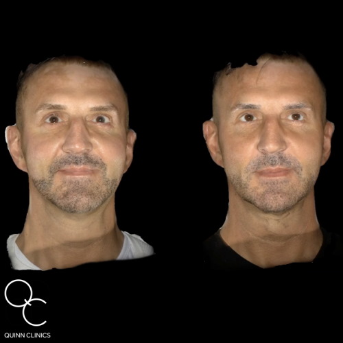 Male Dermal Fillers, Before & After Results