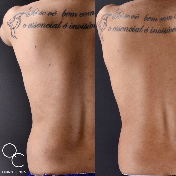 male flanks coolsculpting treatment