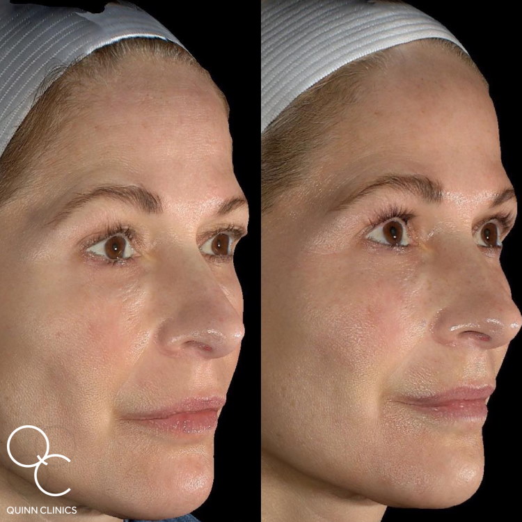 Morpheus8 Radiofrequency Microneedling Results