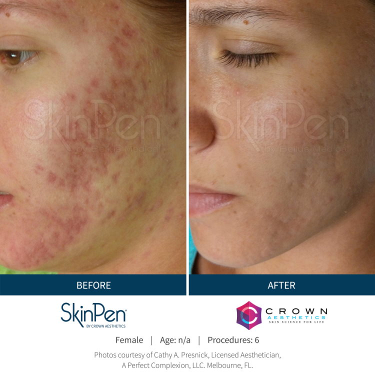Before & After SkinPen Acne Treatment Results Photos