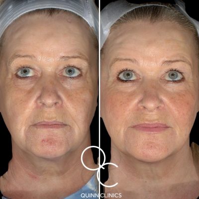 Before and after dermal filler face lift