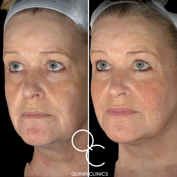 Before & After Dermal Filler Face Lift Results