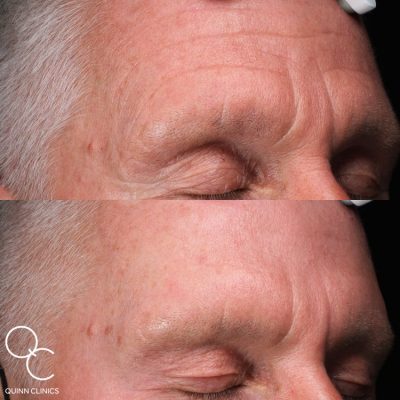 1 Year Male BOTOX® Before & After Results | Quinn Clinics 