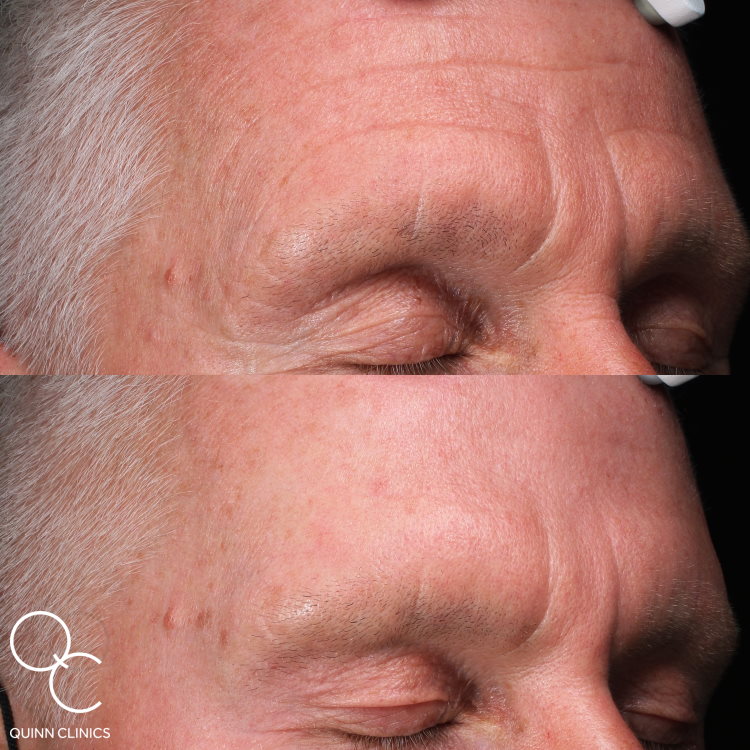 1 Year Later – Male BOTOX® Before & After Results