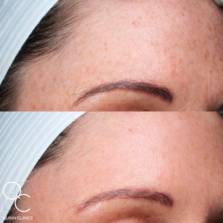 LaseMD Before and After Result