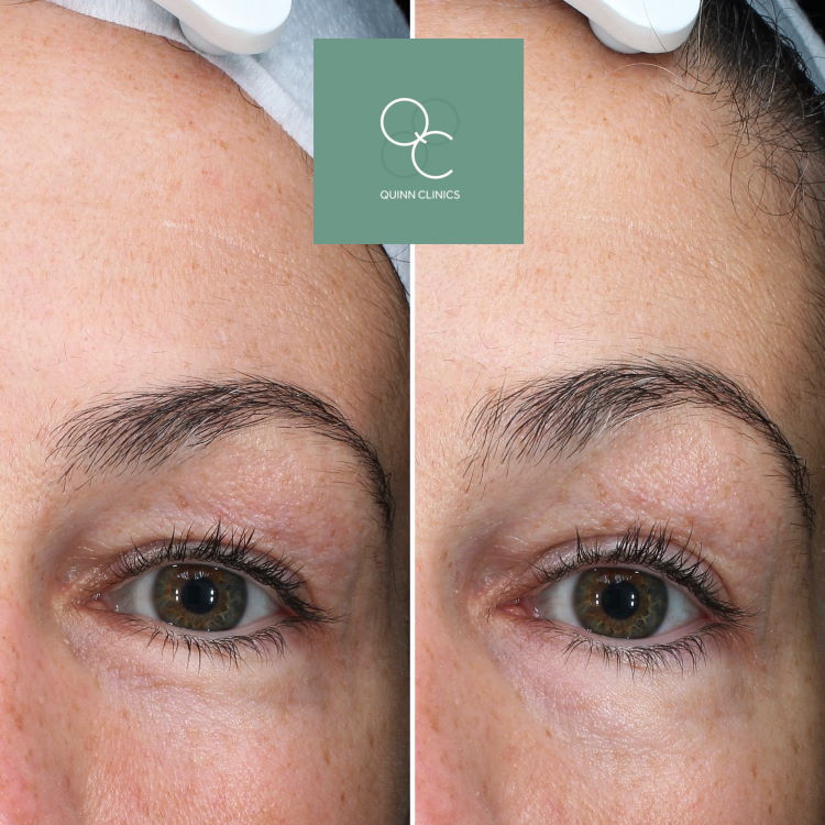 Ultherapy Non-Surgical Brow Lift Results
