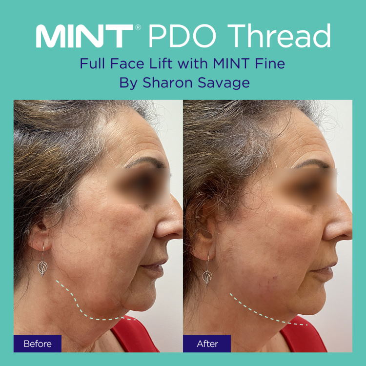 Before and after MINT PDO full face thread lift