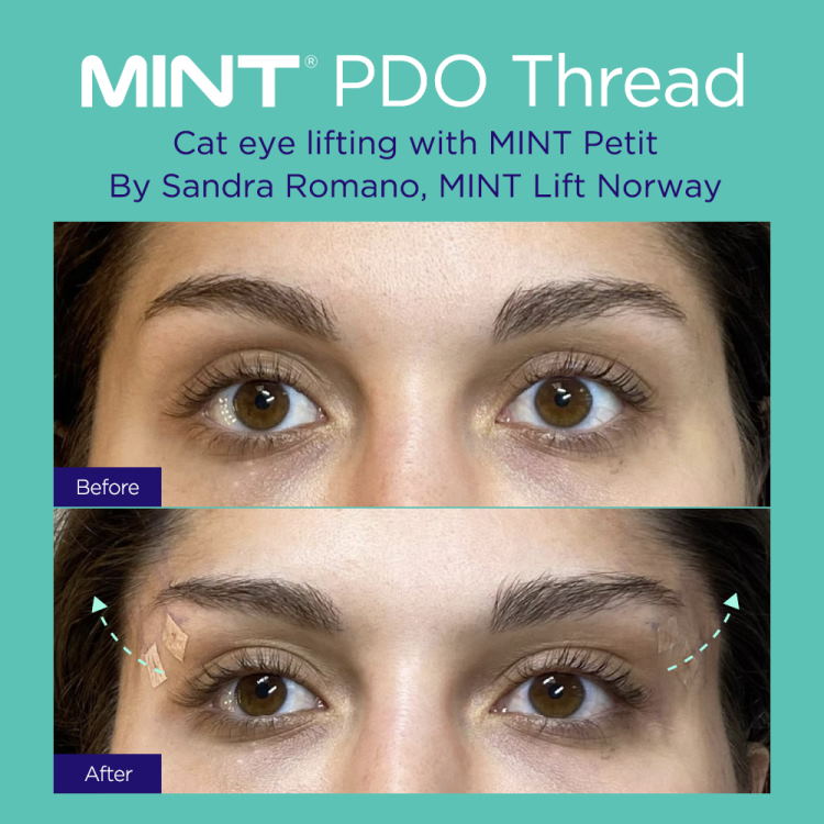 Before and after MINT PDO thread eye lift