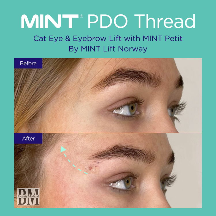 Before and after MINT PDO thread lift and cat eye