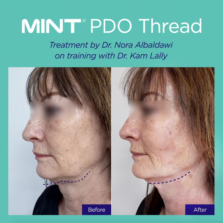 Before and after MINT PDO thread lift jowls jawline