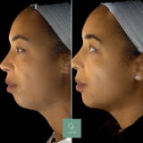 Facial Profiling - Chin Augmentation Improves Balance