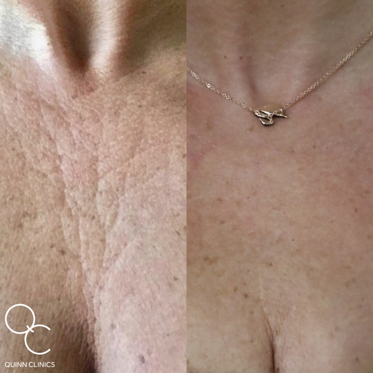 Ultherapy to the décolletage at Quinn Clinics, Bristol