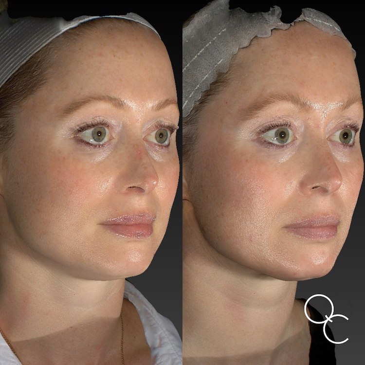 NEW Exilis Before & After Results